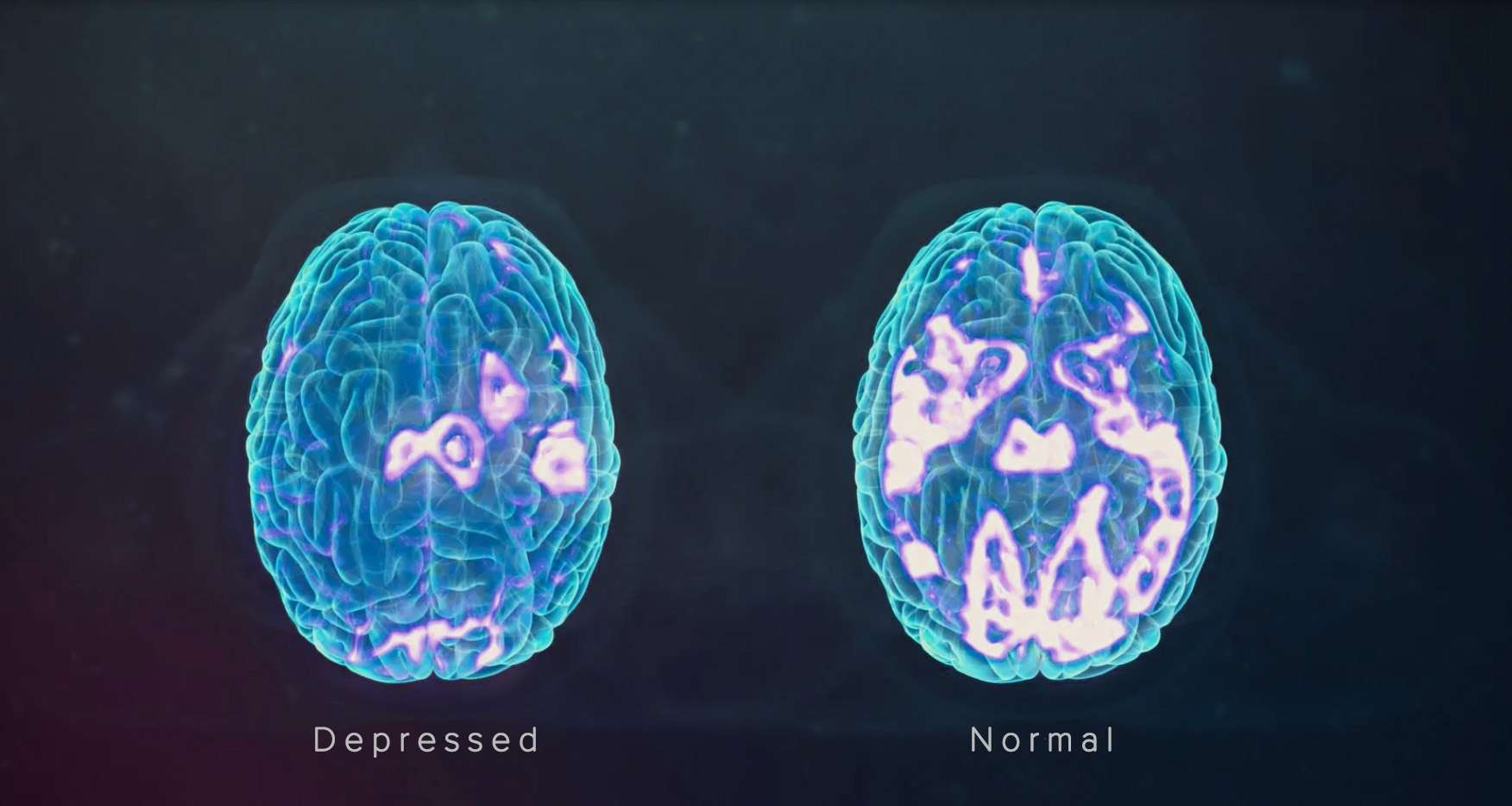 Brain Normally Functioning After TMS